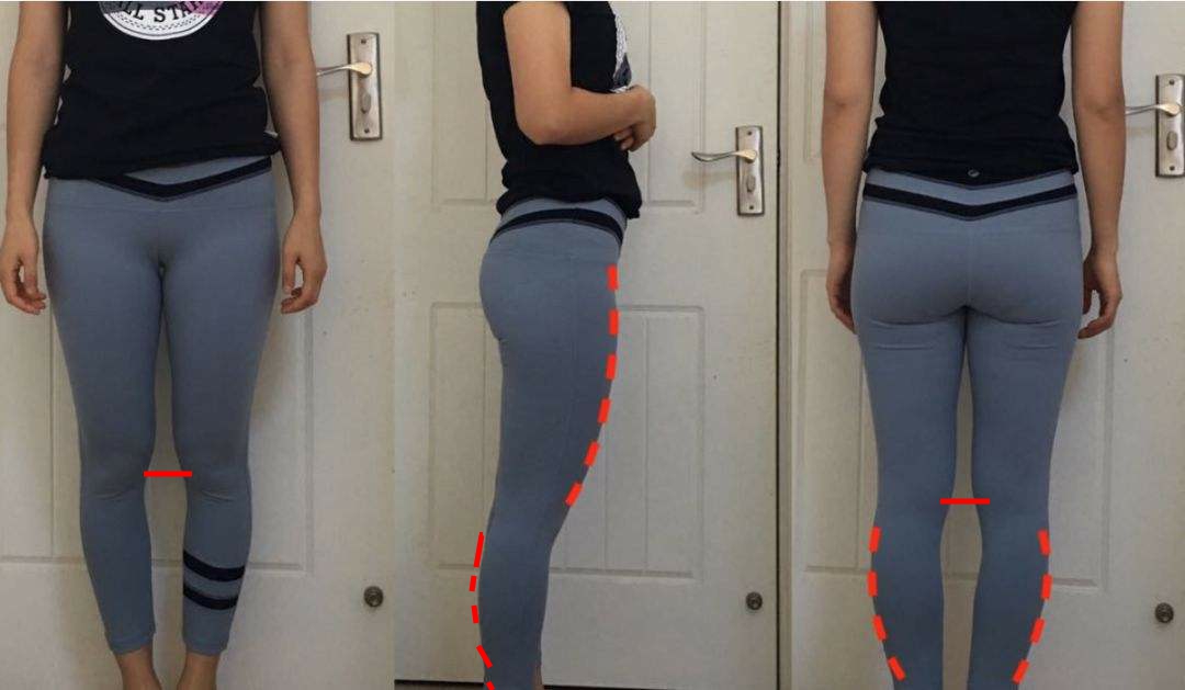 超膝伸肌肉腿怎么矫正,膝超伸和o型腿怎么改善