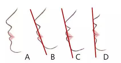 既有牙缝又有露龈笑先矫正哪个,儿童露龈笑最简单改善方法