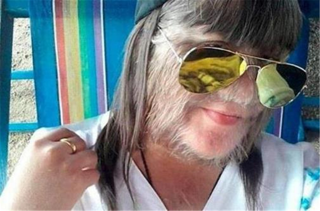 还记得狼人女孩吗？现在为结婚剃去毛发，网友：终于看清脸了