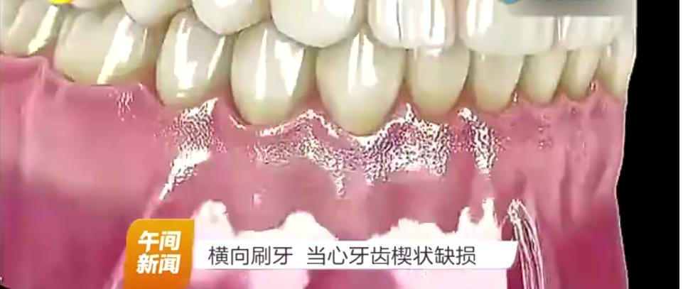 刷牙方式不对导致牙齿有条沟,错误的刷牙方式牙齿还能刷白嘛