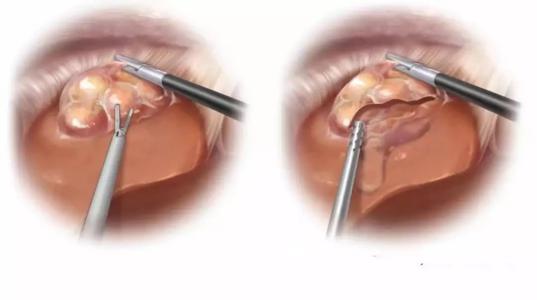 肝衰竭肝囊肿是怎么回事,肝囊肿会引起肝衰竭吗