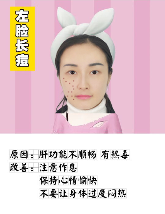 脸上各个位置长痘痘的原因是什么,脸上痘痘的种类及图片