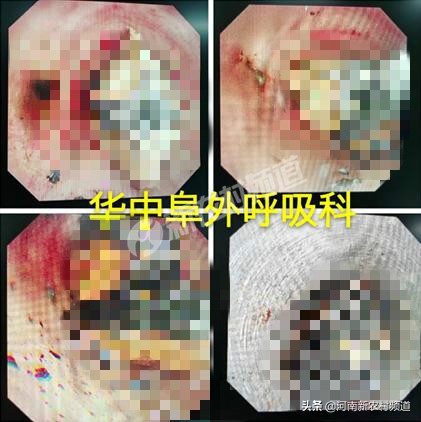 72岁老人误吞枣核后续,81岁老人误吞杏核