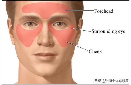 运动性头痛治疗,运动治愈偏头痛