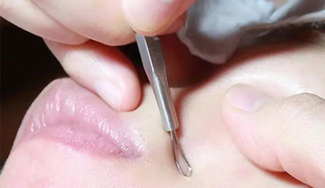 细致皮肤告别草莓鼻,低成本三步告别草莓鼻