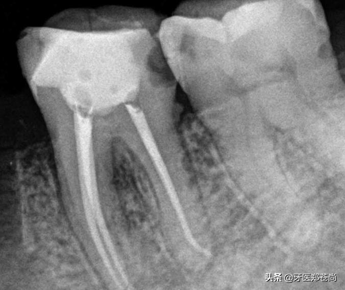 根管治疗又蛀牙了要重新治吗,蛀牙除了根管治疗还能怎么做