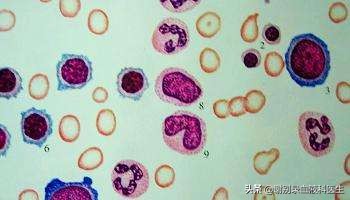 急性淋巴细胞白血病复发的症状,急性白血病完全缓解后会复发吗