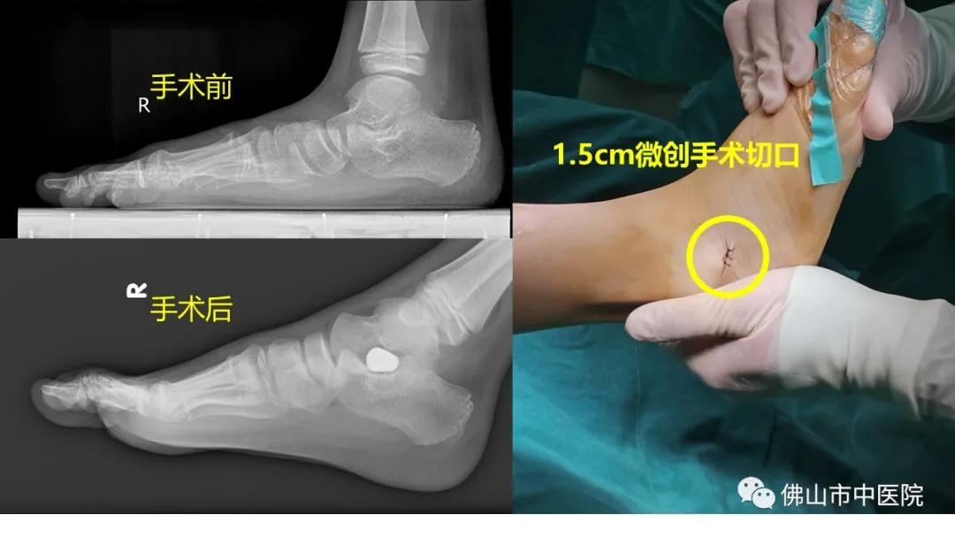 儿童扁平足的矫正训练,儿童矫正扁平足的最佳锻炼方法