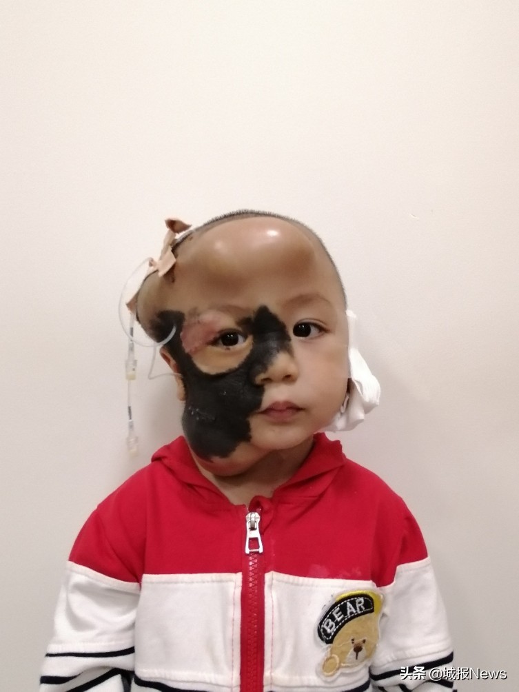 巨痣宝宝治疗费用,巨痣男童