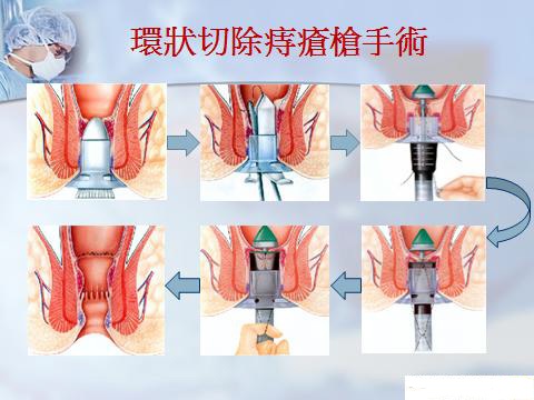 微创是一种理念吗,微创骗局揭秘