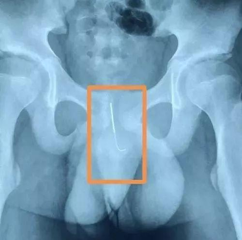 小男孩好奇心太重，把缝衣针插入尿道，孩子人身安全父母要重视