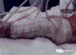 微创伤口换药步骤,如何换药包扎伤口