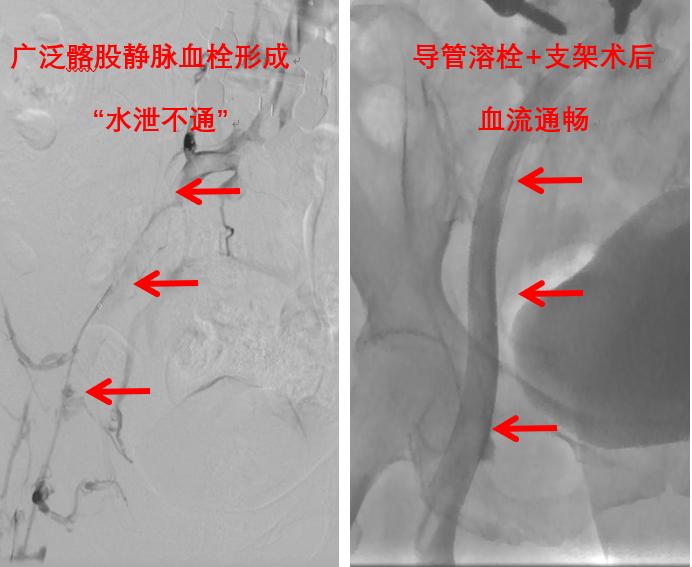 介入不放支架可以吗,介入放支架治标不治本