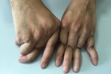 再难治的类风湿也能治好,类风湿治不好