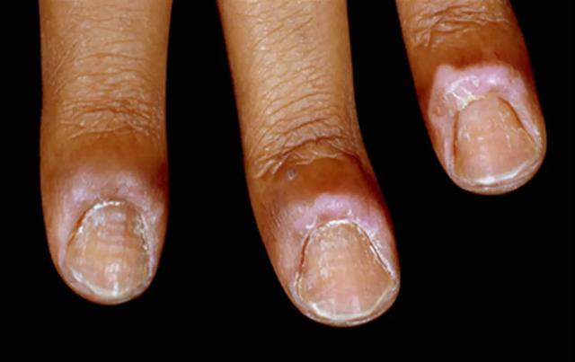 困扰小岳岳的甲沟炎,有没有好的治疗方法?医生给相声粉丝的科普