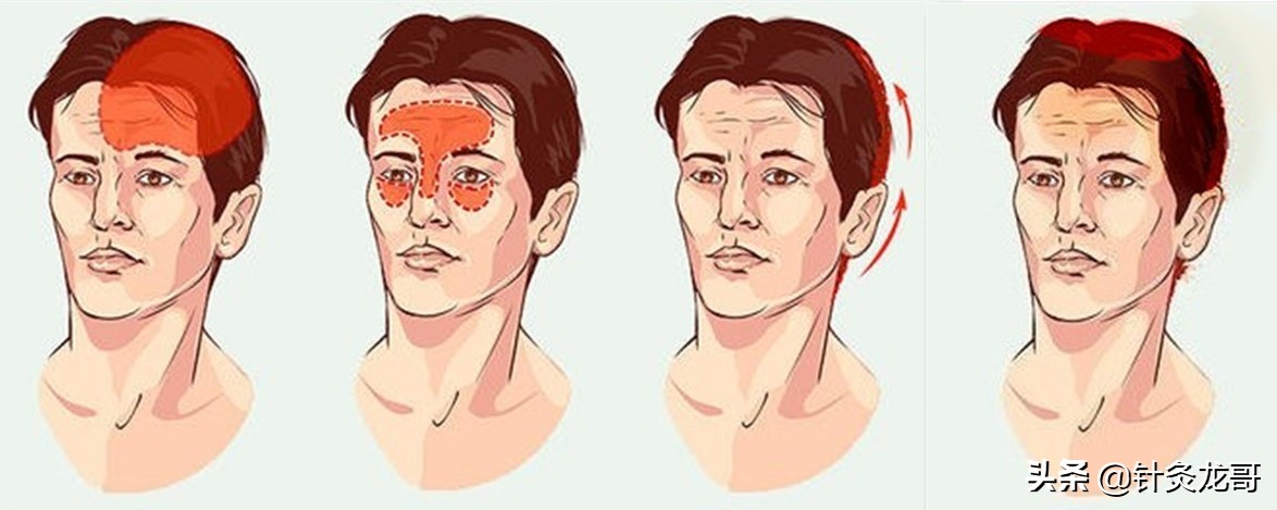 中医针灸头痛穴位图,头部经络走向图推拿手法