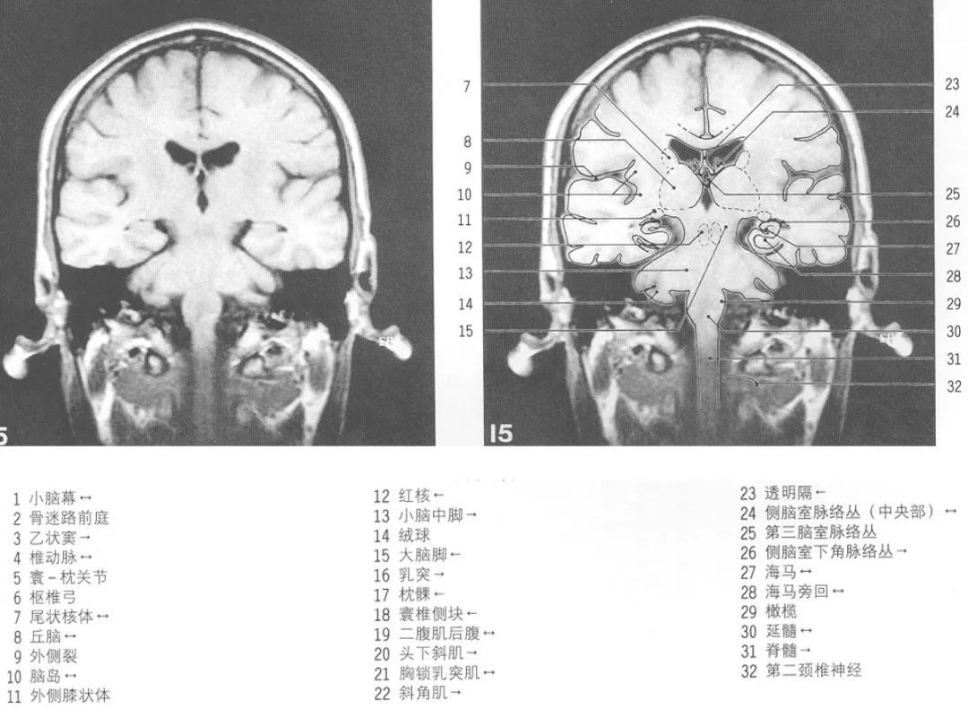 颅脑冠状状切面解剖图,颅脑mr解剖结构图