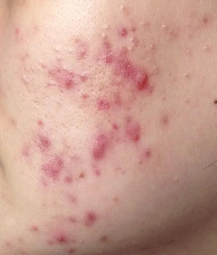 激光祛痘适合哪种痘痘,医学美容科治疗痘痘吗