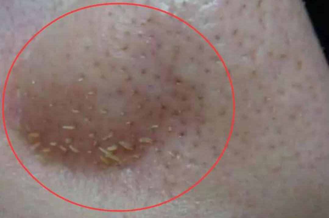 鼻子挤出黄色分泌物是什么,拉出来黄色虫卵是什么虫