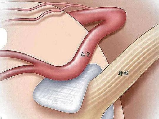 舌咽神经痛症状的原因,怎么确认才是舌咽神经痛