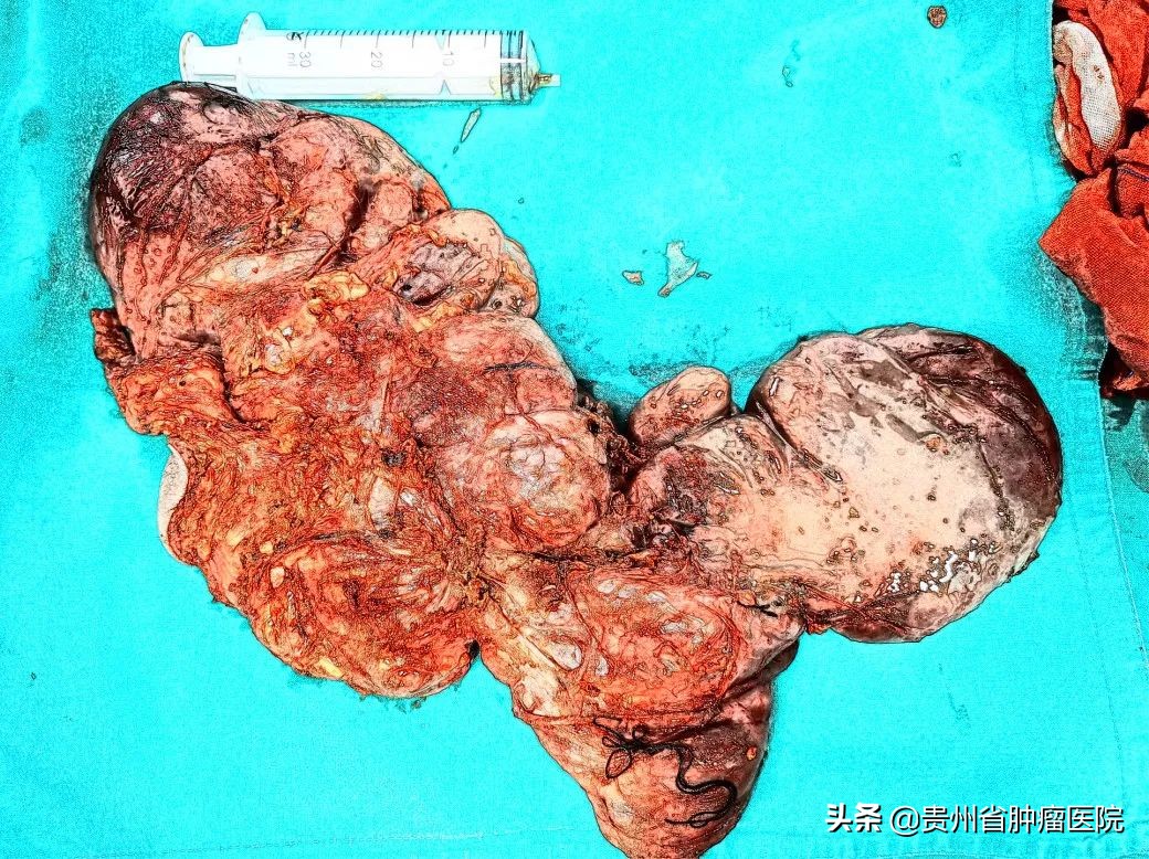 老人屁股肿块迅速长大是什么原因,老人臀部内硬块