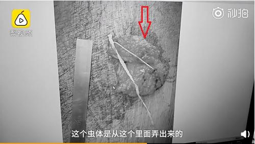 小孩子睫毛感染阴虱,杭州六岁孩子睫毛长阴虱