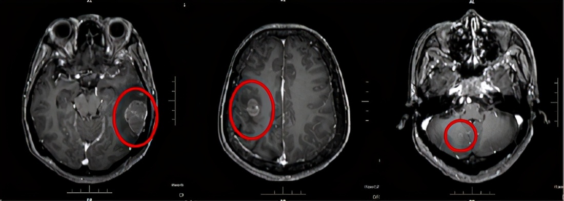 哈医大肿瘤医院化疗放疗在哪里,哈医大一院手术治疗肺癌