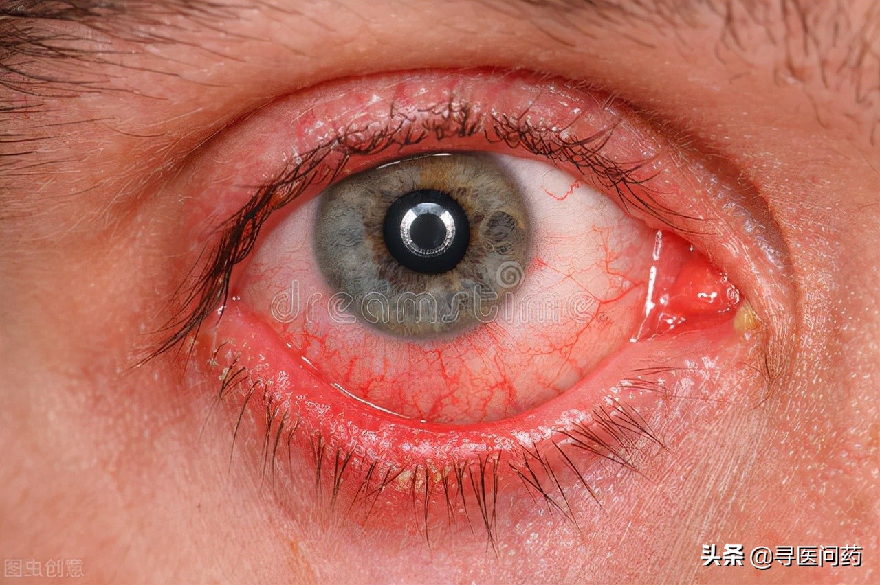 女子眼睛长石头,美女眼睛里长出结石
