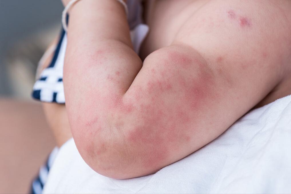 夏季荨麻疹高发期如何应对,麻疹最快的解决方法