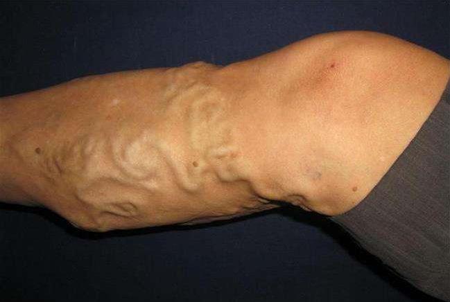 大腿上出现蚯蚓似的血管怎么回事,小腿血管像蚯蚓一样怎么治