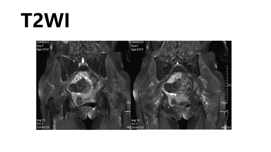 卵巢原发肿瘤的分析思路