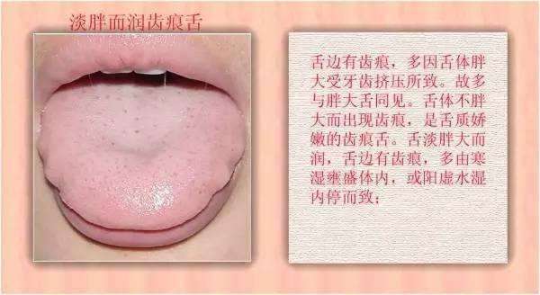 胃火中医辨证论治,胃火肝胆湿热中医辨证论治