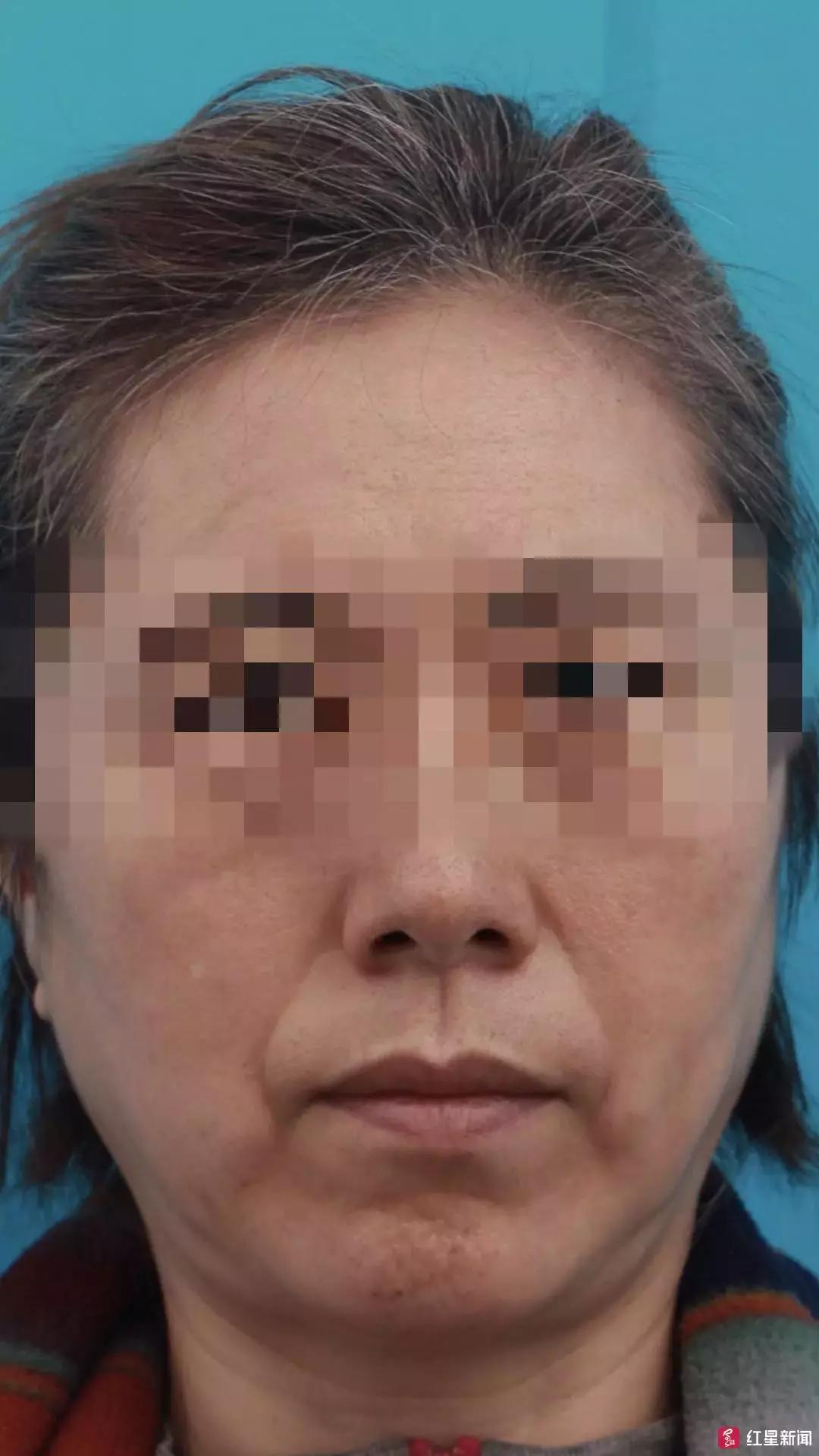 女子花6万整容后仍坚持离婚视频,女子花3万6整形却闭不上眼