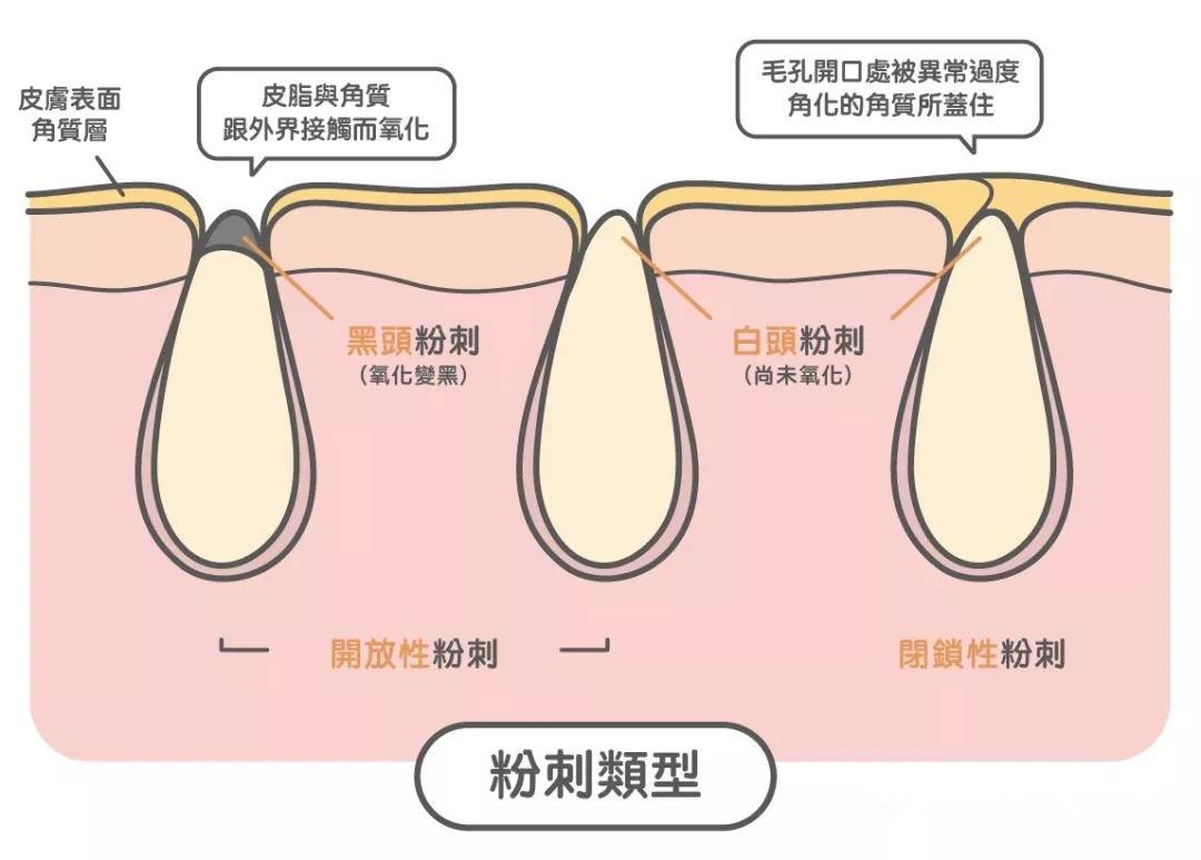 护肤为何毛孔变大脱皮,护肤为什么老闷痘