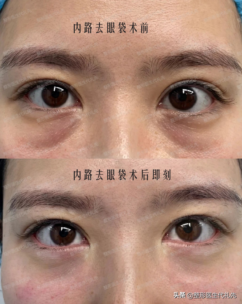 眼袋遗传的原因,眼袋大最简单手术去眼袋的方法