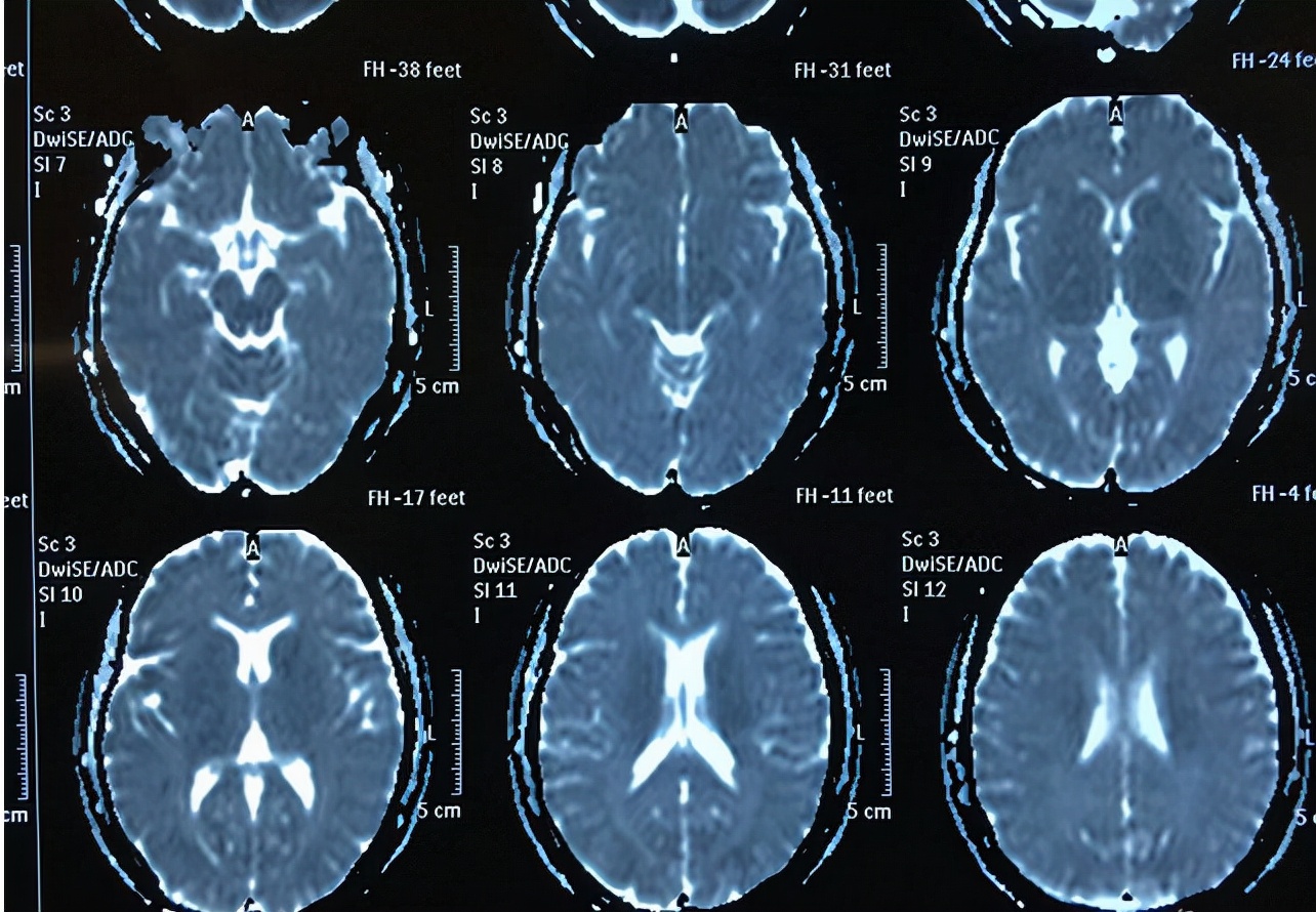 病毒性脑炎引发癫痫怎么缓解,儿童脑炎引发的癫痫能痊愈吗