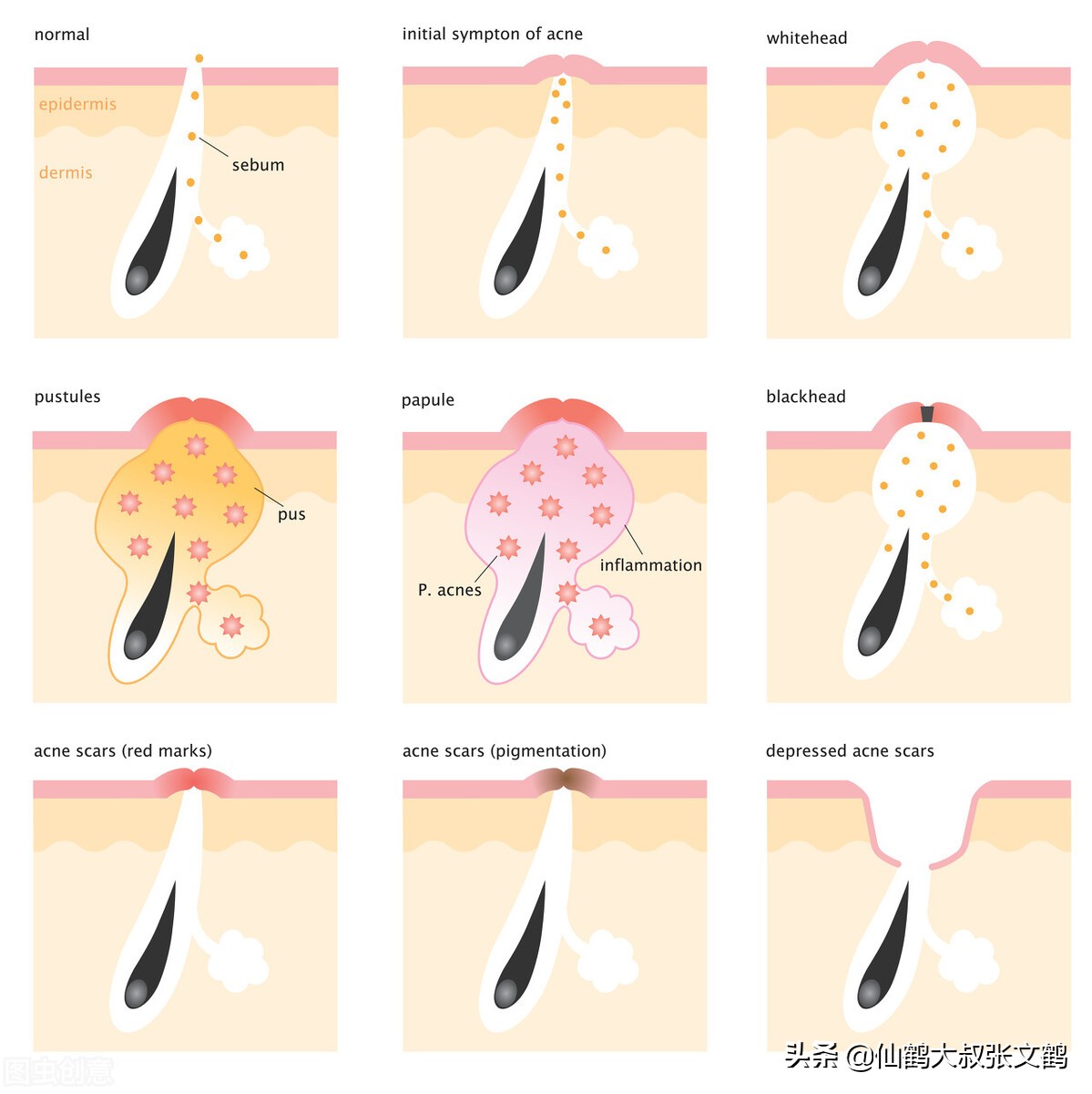 去黑头最直接有效的方法是什么,去黑头最有效的方法偏方