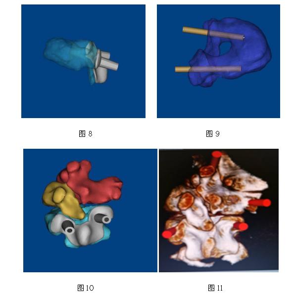 特发性脊柱侧凸的康复治疗方法,先天性脊柱侧凸