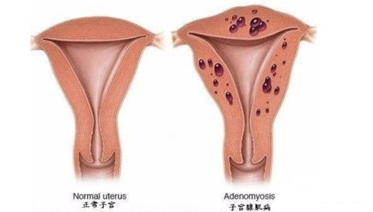 孕育宝宝会遇到哪些困难,子宫畸形的六种情况