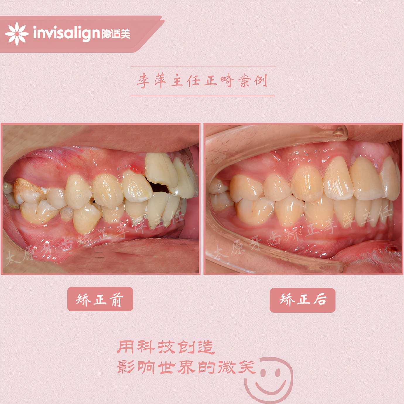 重度牙齿拥挤矫正经历,太原矫正牙齿需要多久