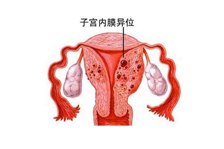 绝经综合症治疗方法,假孕疗法与假绝经疗法的区别