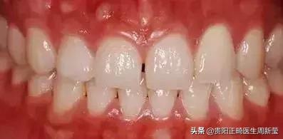 牙齿以前齐现在不齐是什么原因,牙齿排列整齐牙缝大前门牙凸