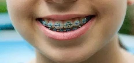 牙齿矫正方案动态图在哪里查看,牙齿矫正前后对比动态图