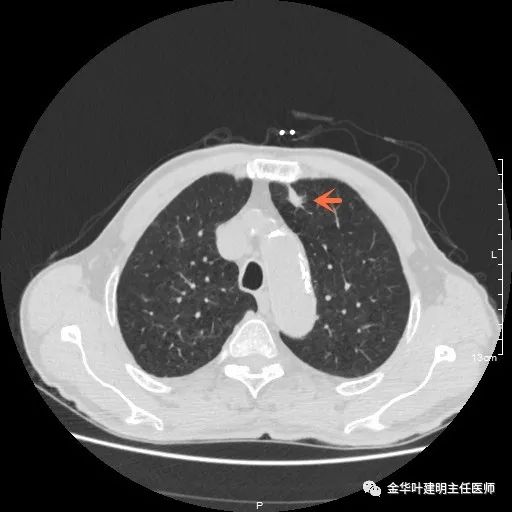 多发原发肺癌能根治吗,肺部原发性恶性肿瘤好治