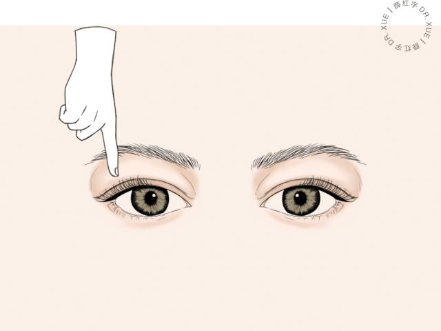 无痕双眼皮大概要多少钱,无痕双眼皮闭眼有痕