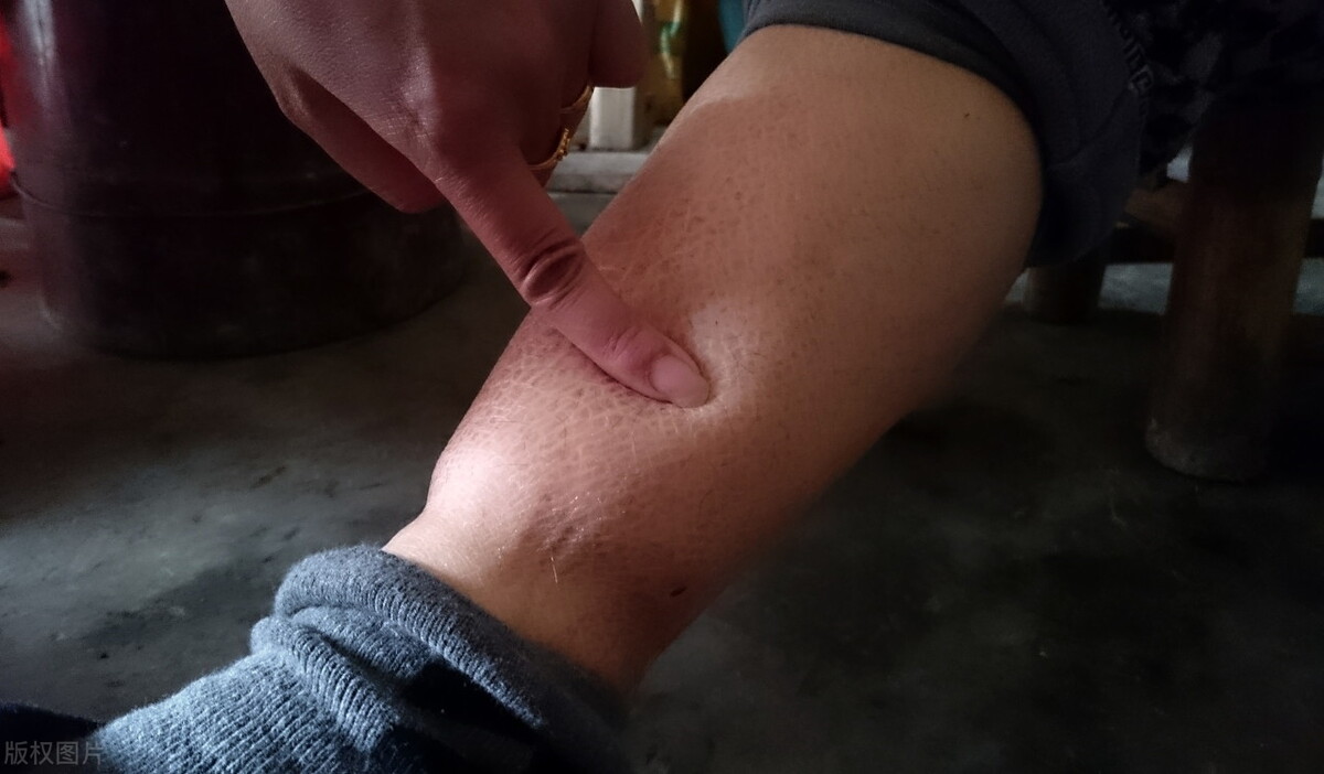 血管脆与血管硬化的区别,血管变脆五个症状