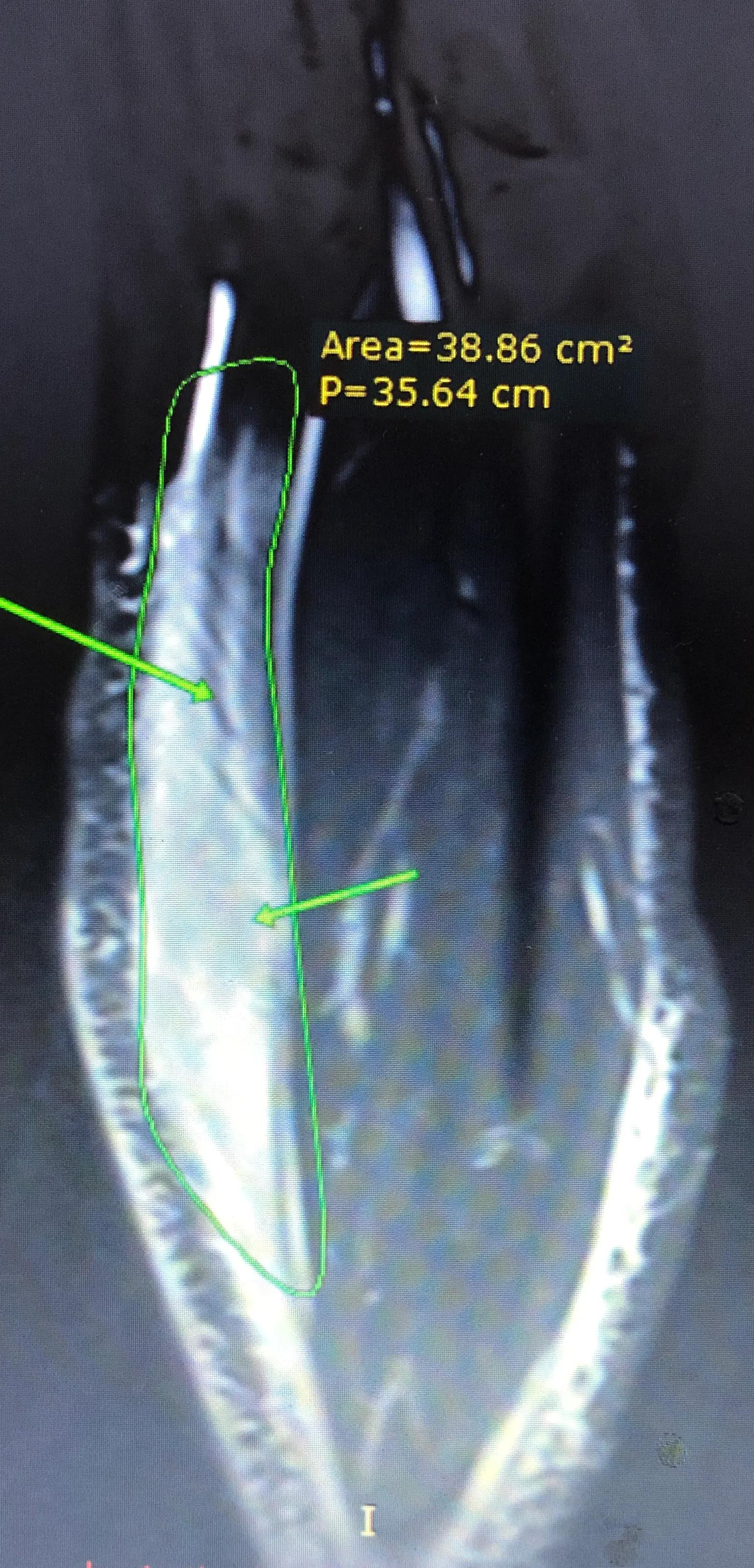 网球腿,网球肘肌腱撕裂