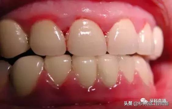 牙疼的滋味没人能理解,牙疼的痛苦有谁能够体会