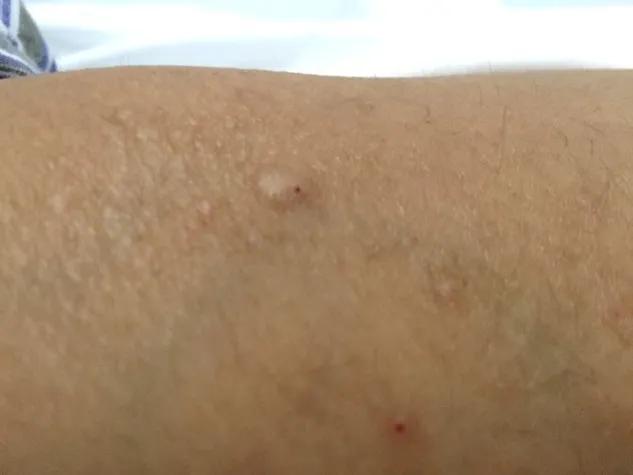 从感冒到癌症,从感冒到癌症只需九步