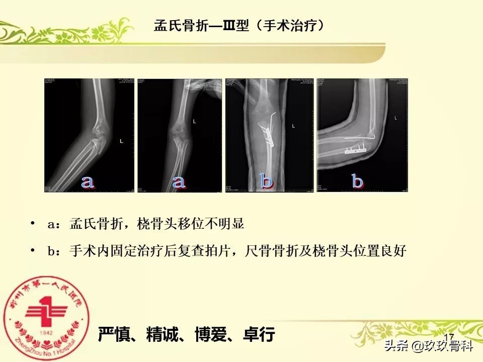 孟氏骨折功能训练多久能恢复正常,孟氏骨折中医能治吗